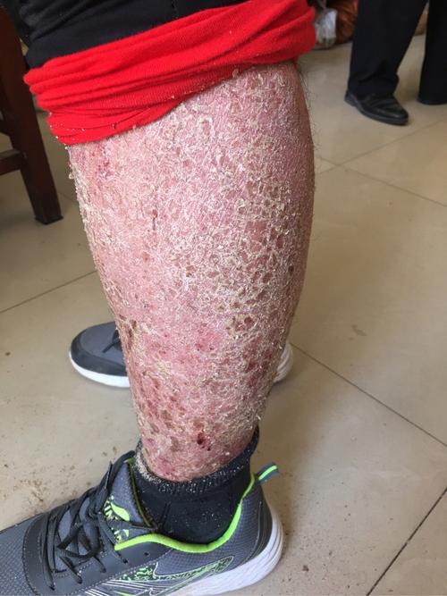 银屑病皮肤脱屑