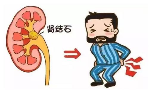 肾结石如何产生