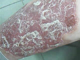 银屑病患者活多久