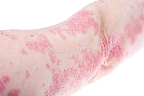 得了牛皮癣应该去哪治疗