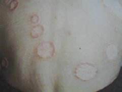 牛皮癣为何总是反复发作