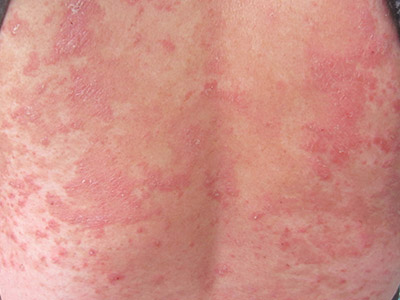 银屑病易恶化怎么做预防