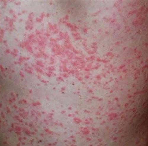 广州银屑病应该去哪治疗