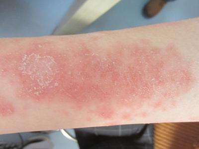 治疗银屑病去广州哪家医院 治疗银屑病去广州哪家医院