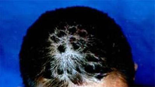 牛皮癣危害有哪些