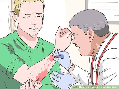 治疗牛皮癣方法