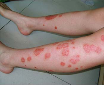 牛皮癣使用什么药方