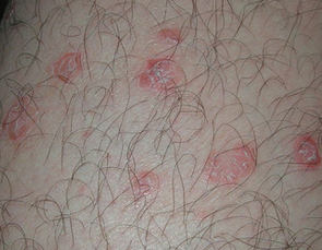 银屑病治疗用啥药