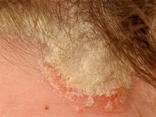 牛皮鲜如何确诊