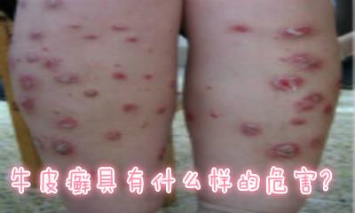 怎么判断牛皮癣