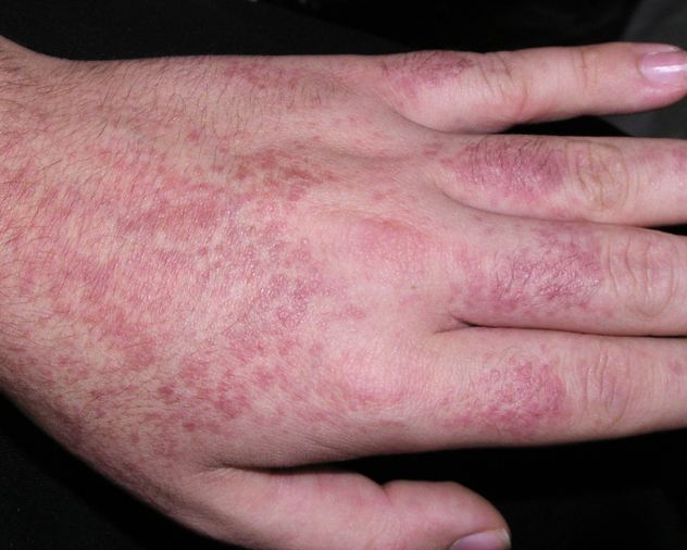 银屑病能治好吗