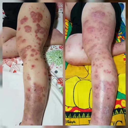 女性患上牛皮癣饮食需要注意啥