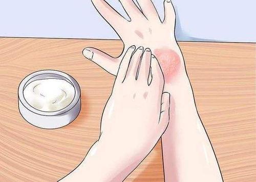 广州治疗牛皮癣好的医院