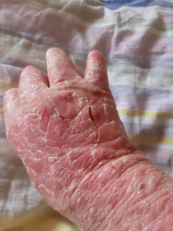 牛皮癣生活习惯还有禁忌