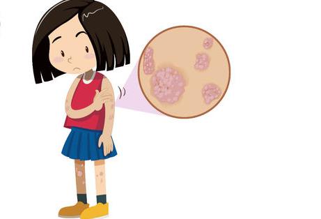 小孩银屑病如何治疗