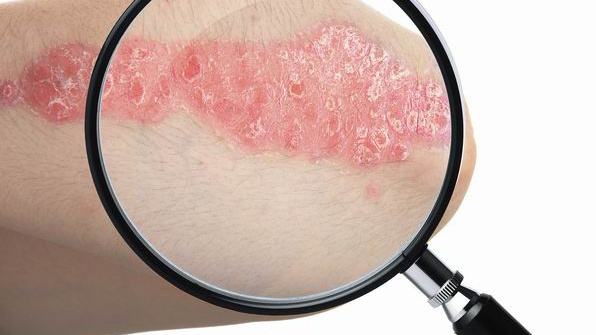 生活中如何预防牛皮癣