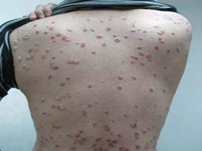 如何判断牛皮癣治疗医院