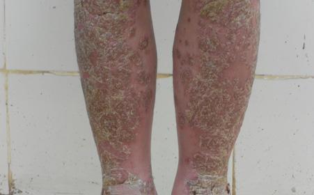 患上牛皮癣之后要注意啥