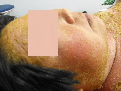 银屑病长在脸上的样子