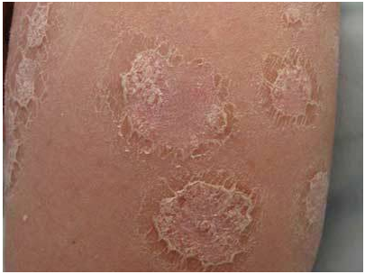 银屑病患者如何挑选医院