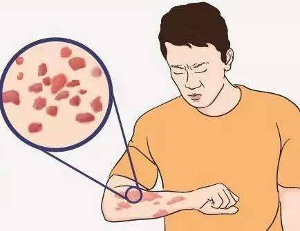 广州银屑病哪里治疗好