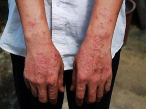 广州牛皮癣专科医院如何