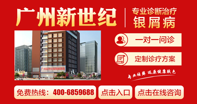 广州治疗银屑病专业