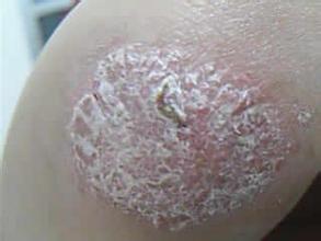 牛皮癣发病初期吃什么好