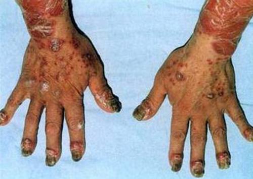 牛皮癣患者能不能吃生鸡蛋