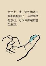 牛皮癣应该去哪治疗