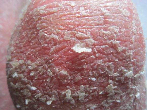 银屑病患者为啥有这么多的鳞屑