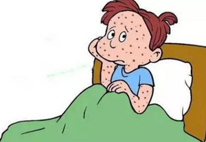 儿童长了牛皮癣怎么治疗