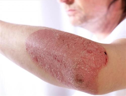 治疗银屑病依赖药物