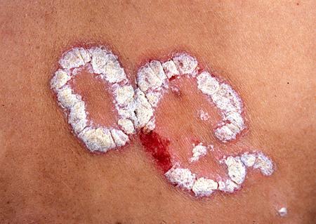 牛皮癣患者脸上有斑咋办