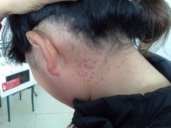 头皮银屑病如何治疗