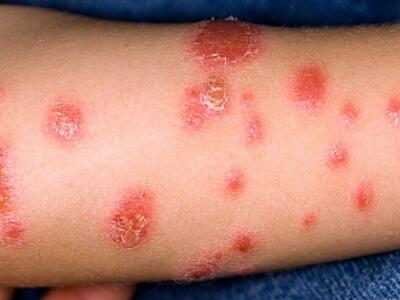 牛皮藓的表现特征