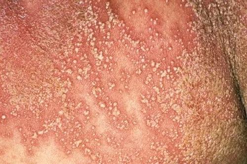 中山哪里治疗牛皮癣