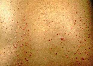 银屑病和季节之间有着什么联系