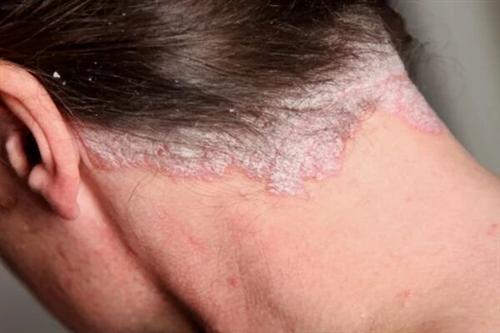 银屑病患者的日常保湿品该如何选择