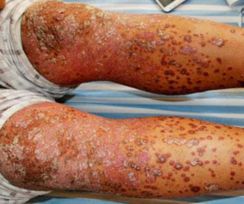 银屑病会有哪些症状