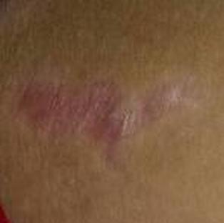 牛皮癣治疗方法