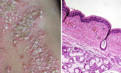 银屑病患者选择健康还是美丽