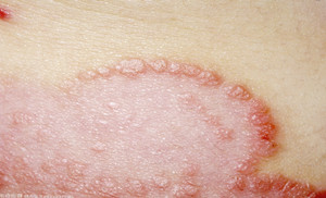 广州哪个医院治疗银屑病