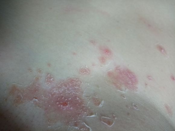 治疗牛皮癣需要多少钱