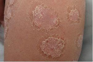 银屑病早期怎么治疗