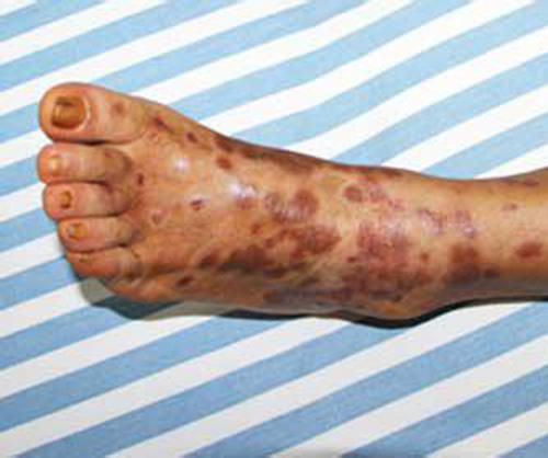 青少年牛皮癣治疗黄金时期