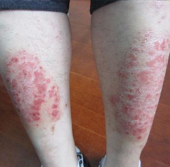 战胜银屑病如何做