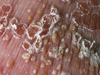 牛皮癣发病原因