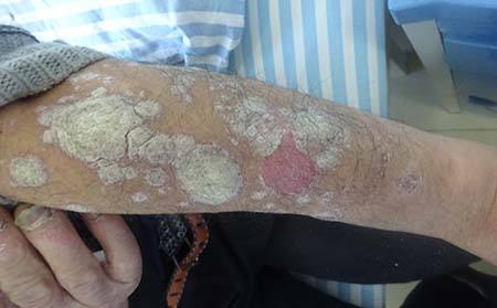 广州哪家医院治疗牛皮癣快