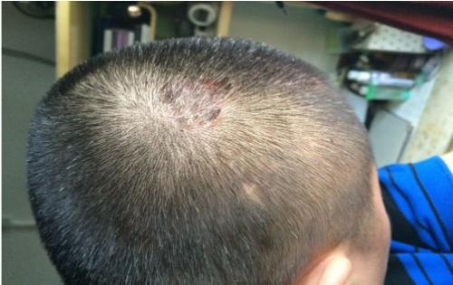 牛皮癣护理需要注意啥